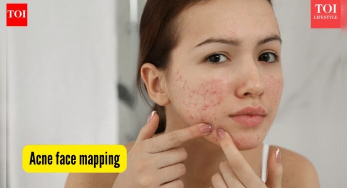Acne mapping: What your breakout patterns reveal about skin, health, and habits