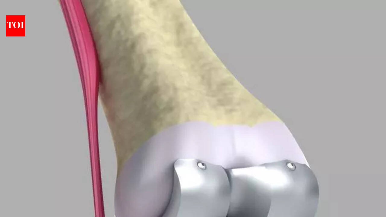 Titanium orthopaedic supply could become a casualty of Gulf crisis | Mumbai News